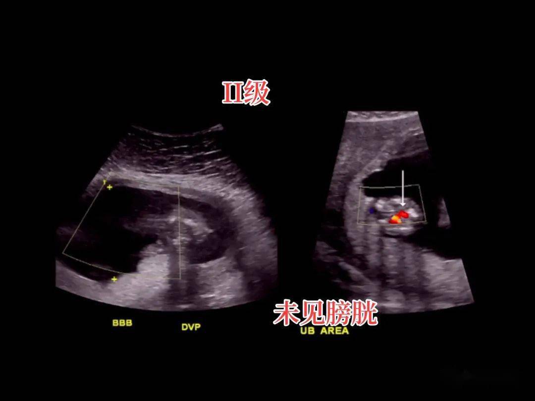 实例讲解双胎输血综合征记忆法_血流_静脉_膀胱