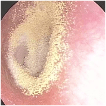 外耳道真菌病也称为霉菌性外耳道炎,是一种特殊类型的外耳道炎