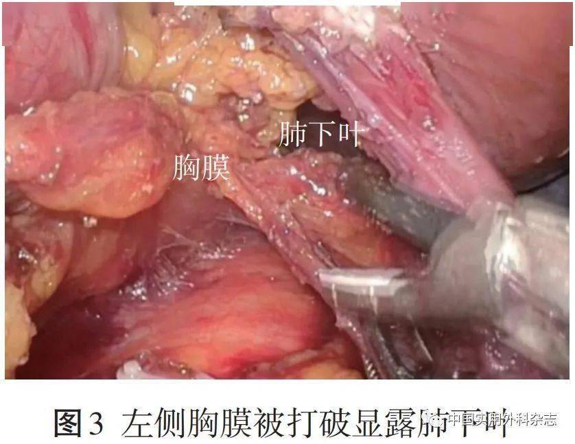 論著經食管裂孔下縱隔淋巴結清掃在siewertⅡ型食管胃結合部腺癌根治