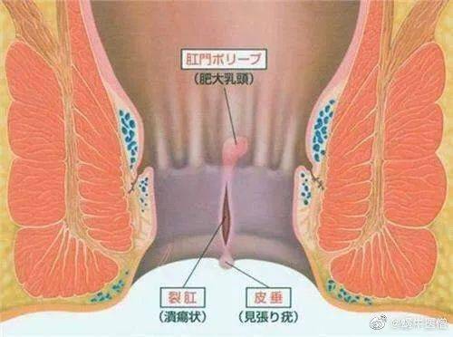 肛裂的症状三期图片