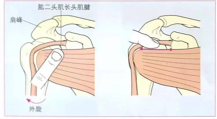 肩痛中最容易被忽視肩胛下肌怎麼檢查它