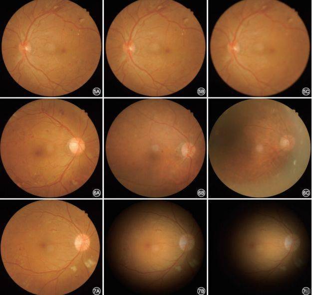 我國糖尿病視網膜病變篩查的圖像採集及閱片指南(2017年)_眼底_患者_