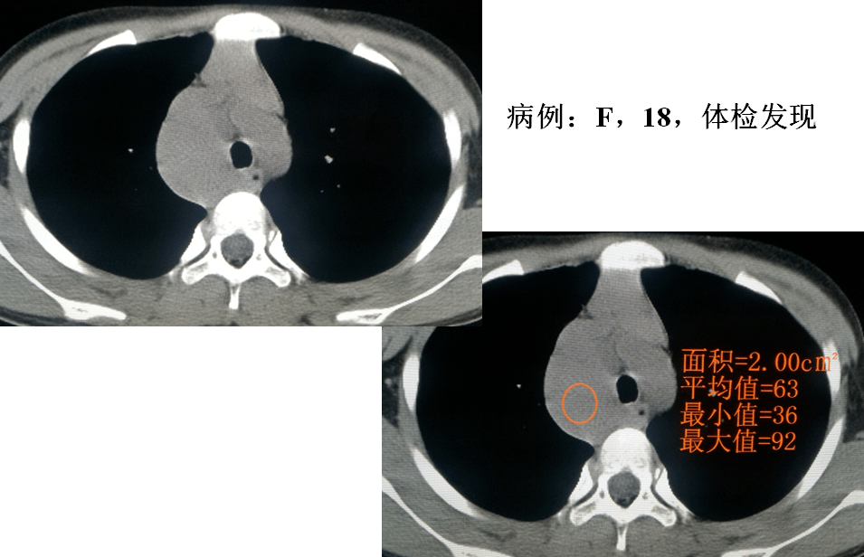 李智勇教授见微知著纵隔病变的mri成像