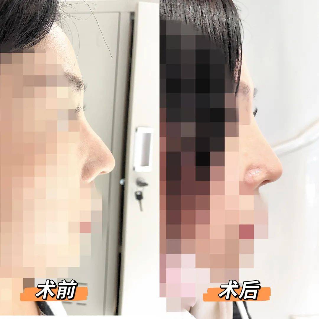 向医生徐州女子花三万多隆鼻，鼻子没“翘”？