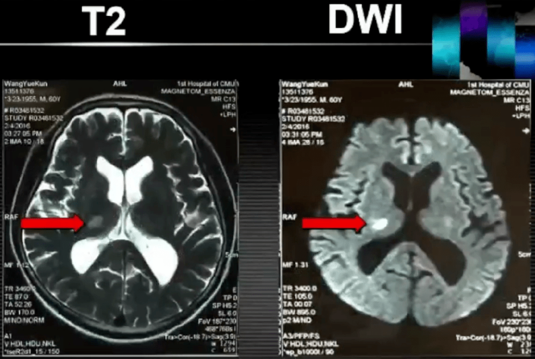 颅脑mrl示双侧后枕部皮下脂肪瘤,t2及dwi示:右侧丘脑近期梗塞灶.