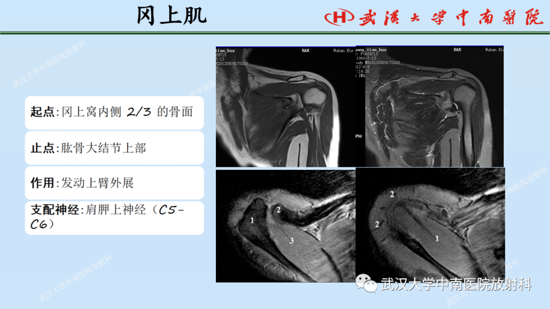 肩关节解剖图mr图片