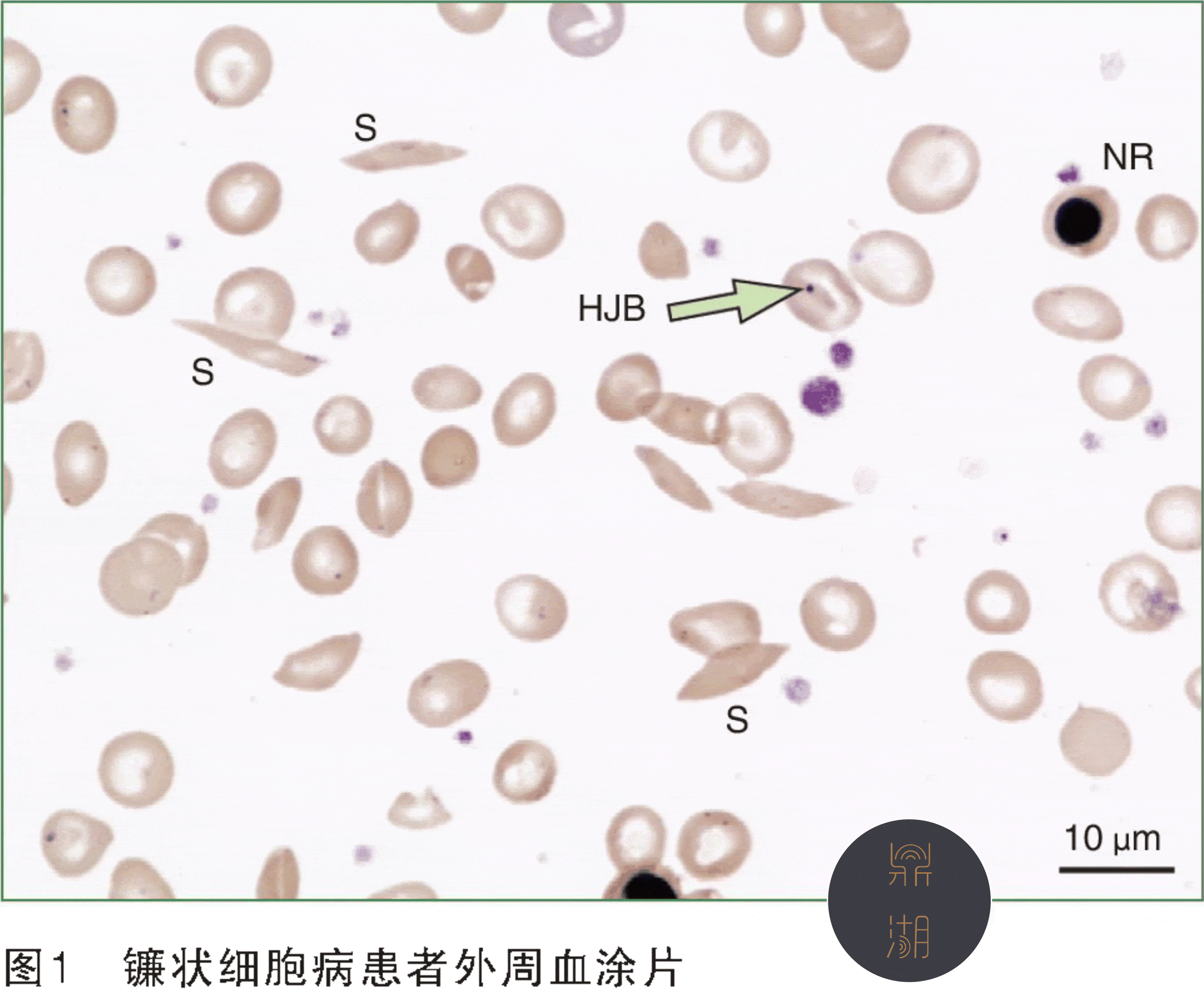 涨见识了,这种形态的椎体提示贫血_镰状_细胞_包括