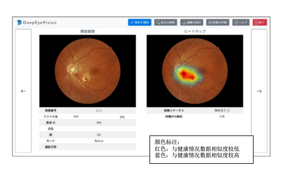 尼康与deepeyevision共同开发人工智能眼底相机程序_诊断_显示_日本