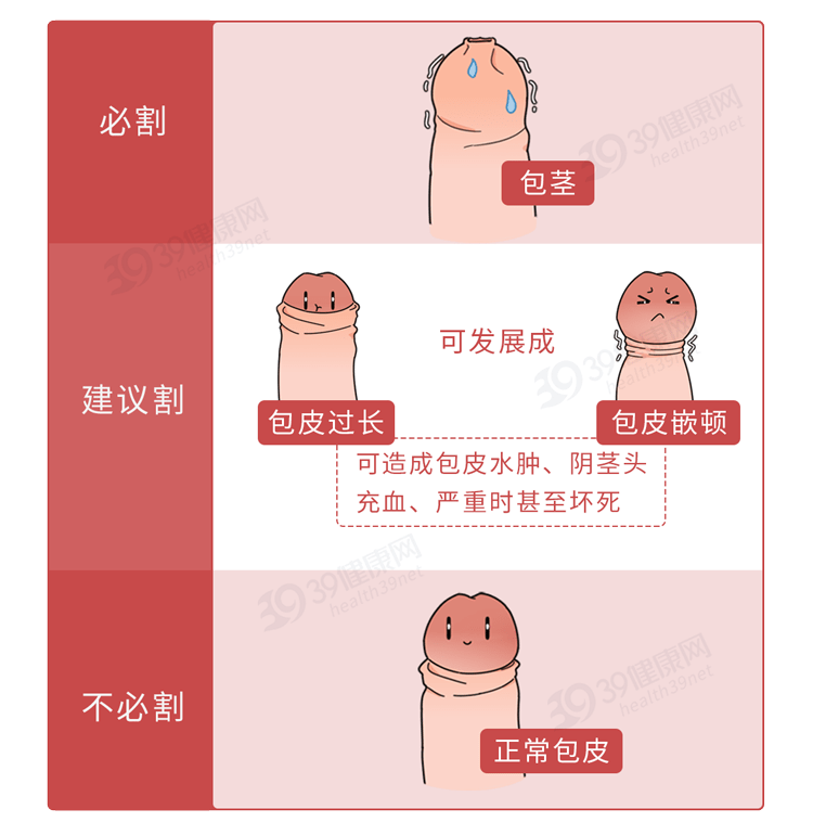 割包皮有什么好处什么程度需要做手术建议男生们都看看