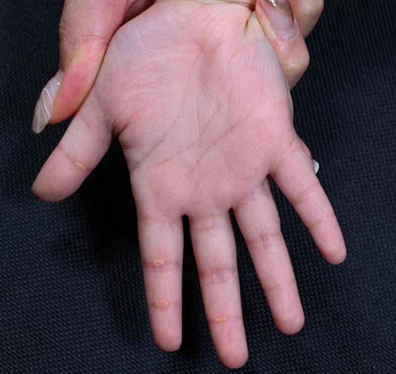 2岁孩子手掌不断长出黄疙瘩,原来是患上了罕见病