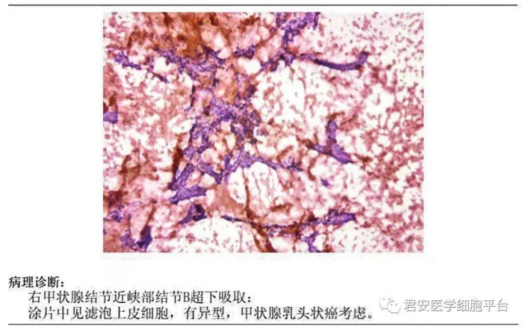 2021-12-7日在超聲引導下甲狀腺右葉近峽部結節細針穿刺活檢:常規消毒