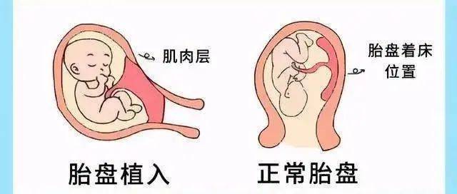 重度子痫、胎盘植入，这个新武器为二孩妈妈竖起抵御屏障_黄晓英_子宫_晓蕾