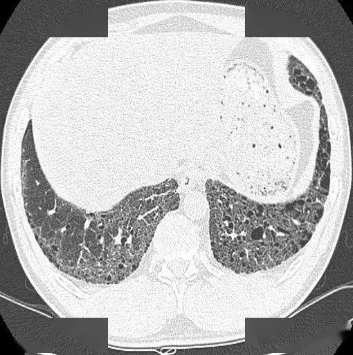 胸部|这个间质性肺炎，还挺少见的