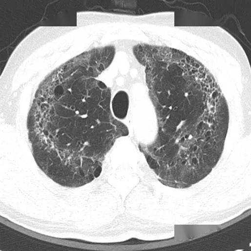 胸部|这个间质性肺炎，还挺少见的