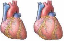症状|一场小感冒，竟让心脏变大？心脏变大事不小，严重的竟要“换心”？