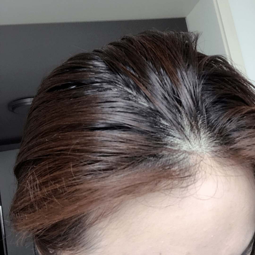 头皮头屑暴增？头皮扣下“白泥”？用Ta,帮你揪出头屑“内鬼”！清爽柔顺，发量翻一番！