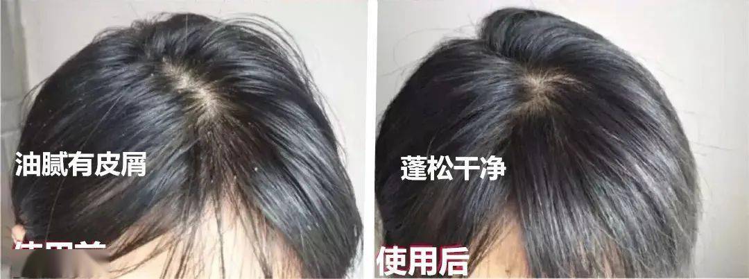 头皮头屑暴增？头皮扣下“白泥”？用Ta,帮你揪出头屑“内鬼”！清爽柔顺，发量翻一番！