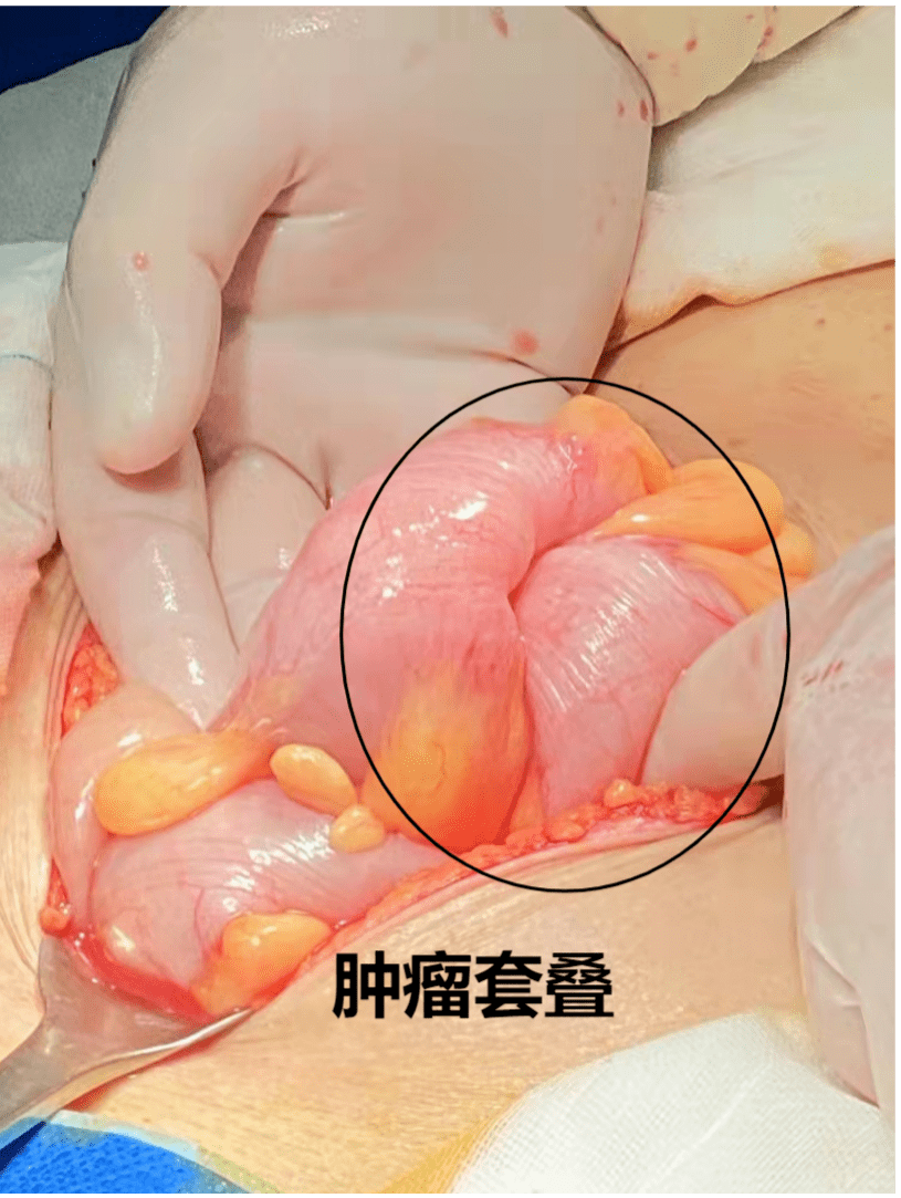 胡石甫医师在门诊肠镜检查中发现,患者乙状结肠肿瘤占位合并肠腔狭窄