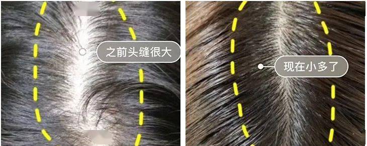 头皮头屑暴增？头皮扣下“白泥”？用Ta,帮你揪出头屑“内鬼”！清爽柔顺，发量翻一番！