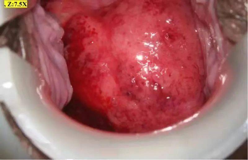 宫颈癌流出的液体图片图片