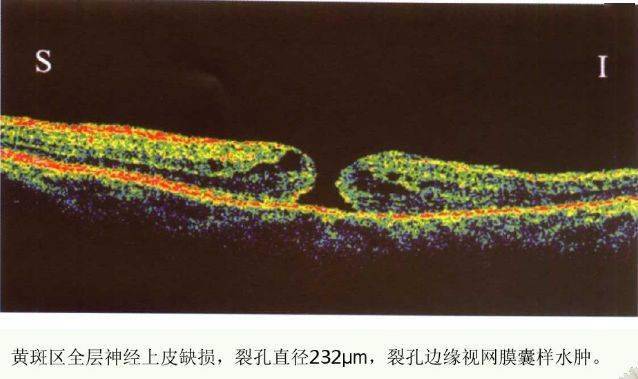 眼科新手必備:oct基礎知識_屈光_進行_矯治