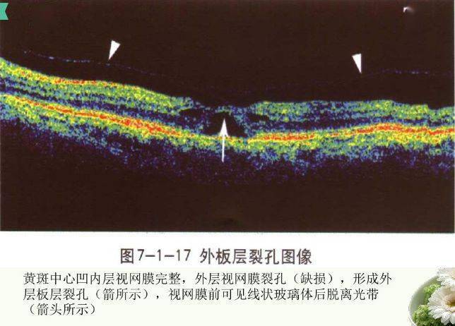 眼科新手必备oct基础知识