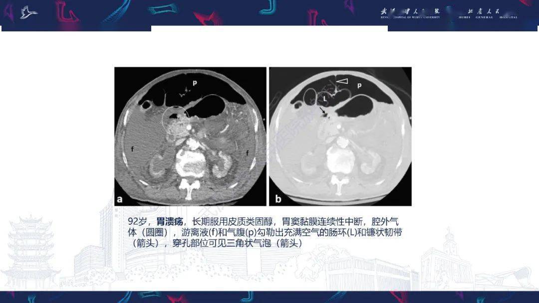 胃肠道穿孔ct诊断