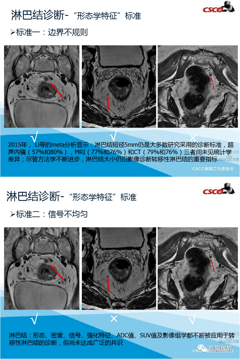 直肠癌mri解剖扫描规范影像学评价结构式报告一文整理