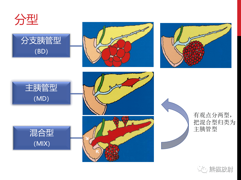 讲座丨胰腺导管内肿瘤的影像诊断孙丛教授