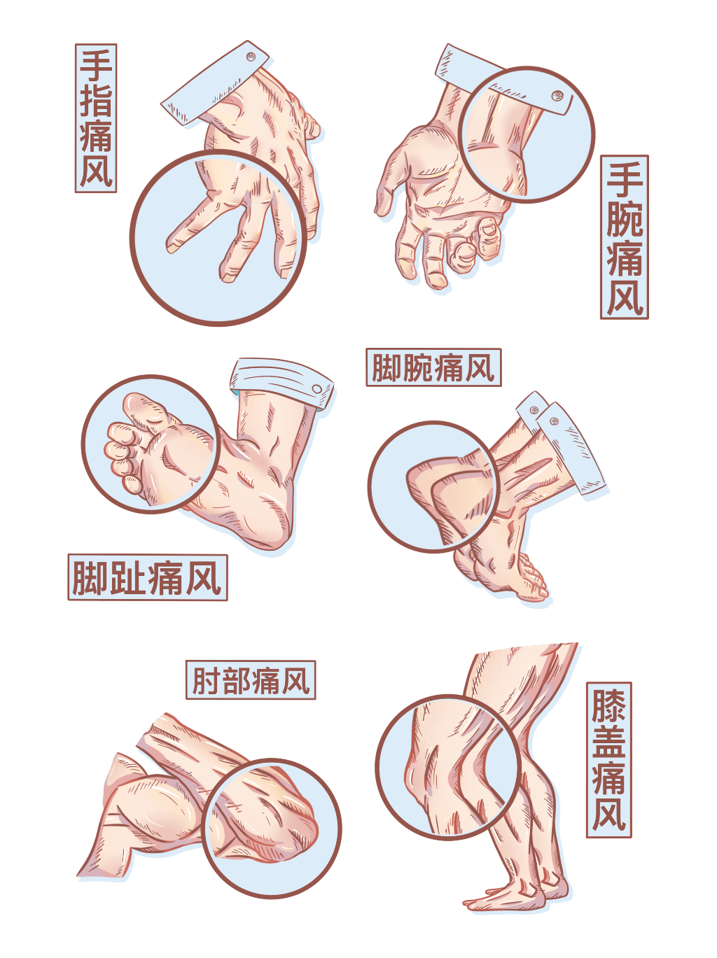 为什么得痛风的人越来越多?看看你有几点中招!_尿酸_关节炎_降低