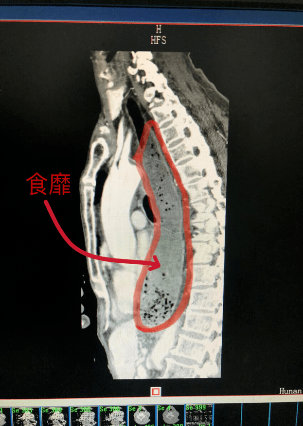 通过胃镜检查