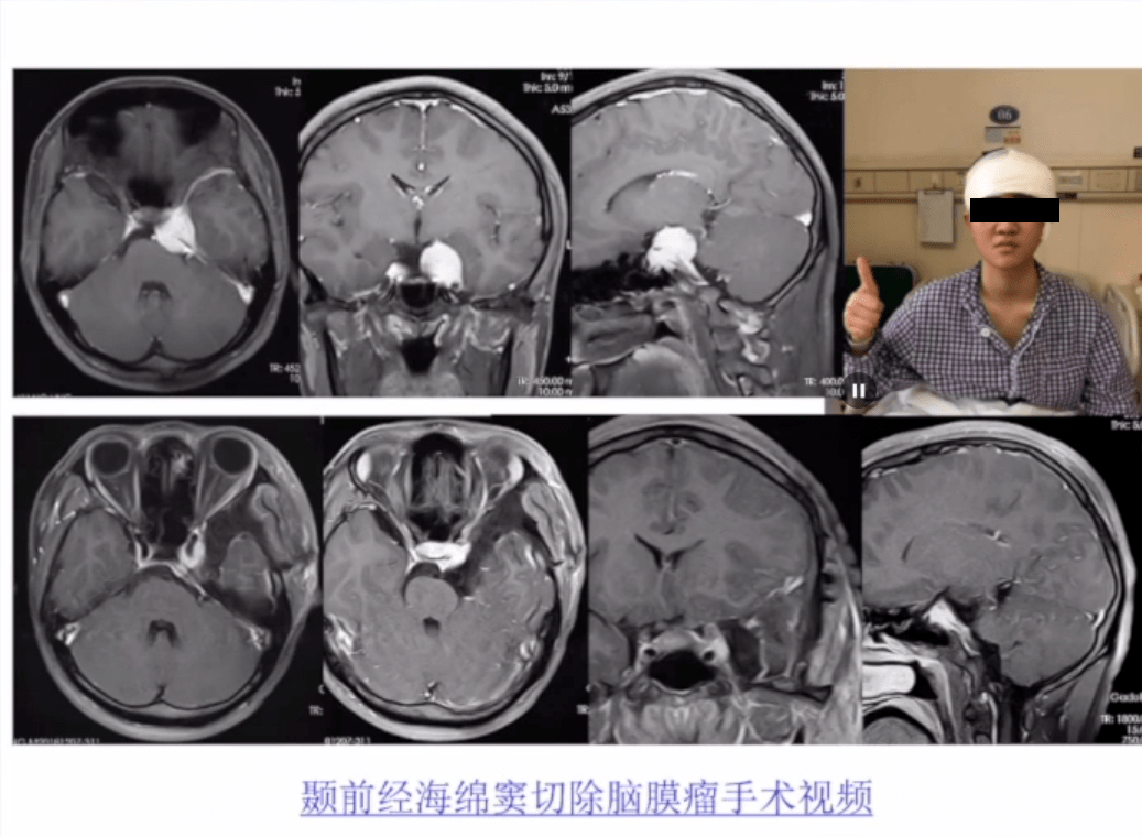 精彩回顾刘庆主任岩斜区脑膜瘤的分型与手术入路选择再探讨
