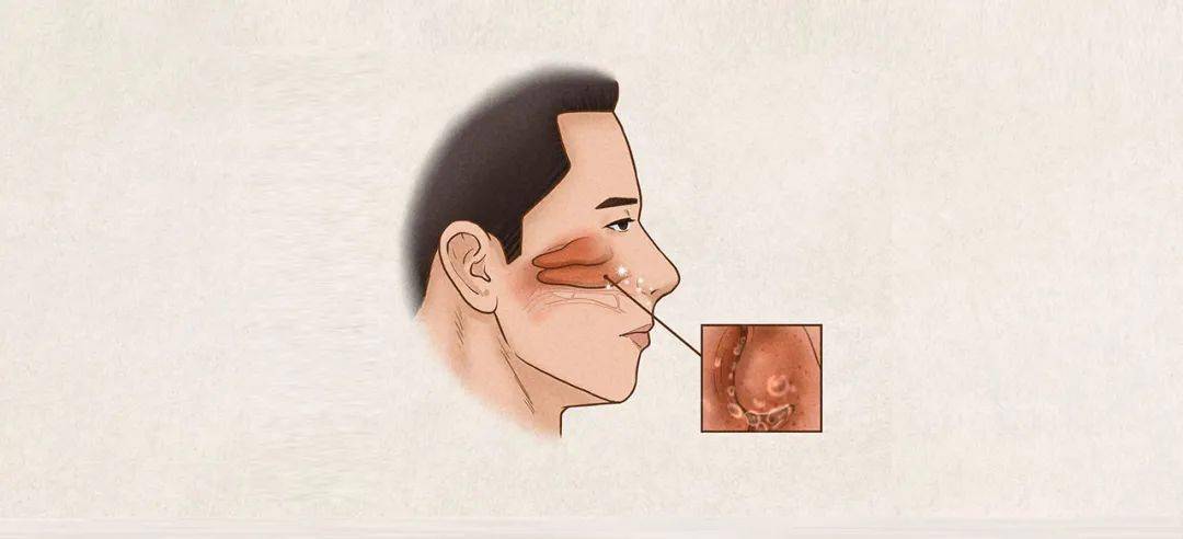 得了过敏性鼻炎很难受,忍它还是治它?_药物_鼻腔_患者