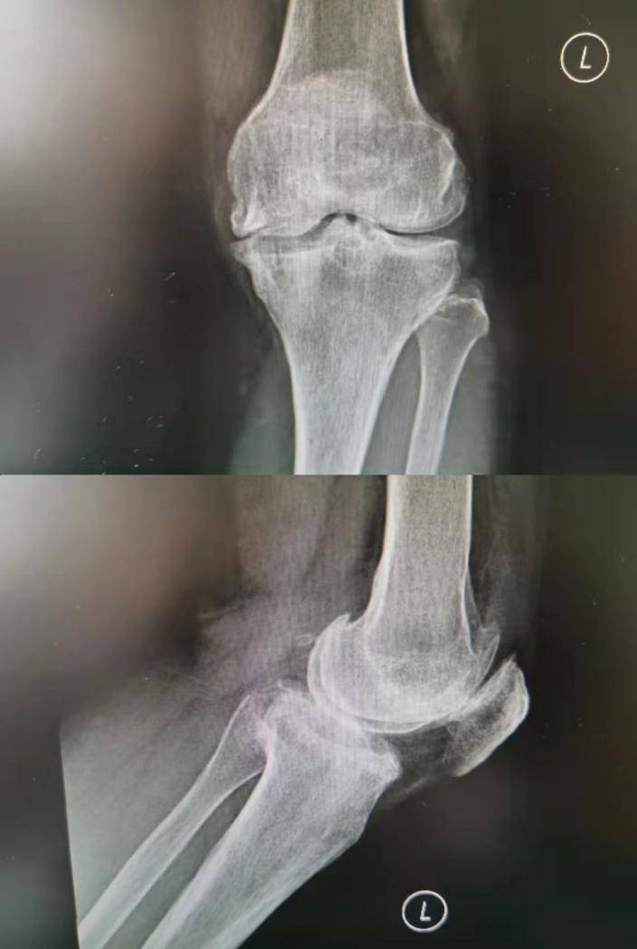 手术|年纪轻轻膝盖软骨被完全磨损，人工关节置换助其恢复行走