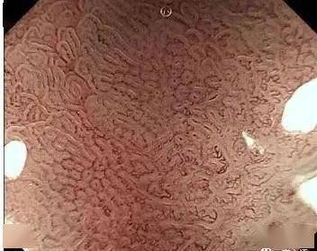 胃印戒细胞癌胃镜图片图片