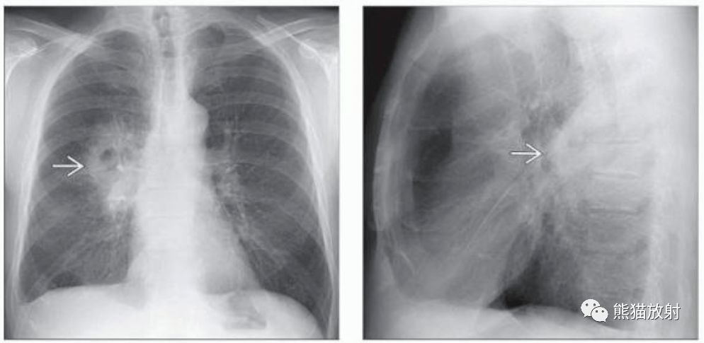 肺脓肿,脓毒性肺栓塞丨影像表现