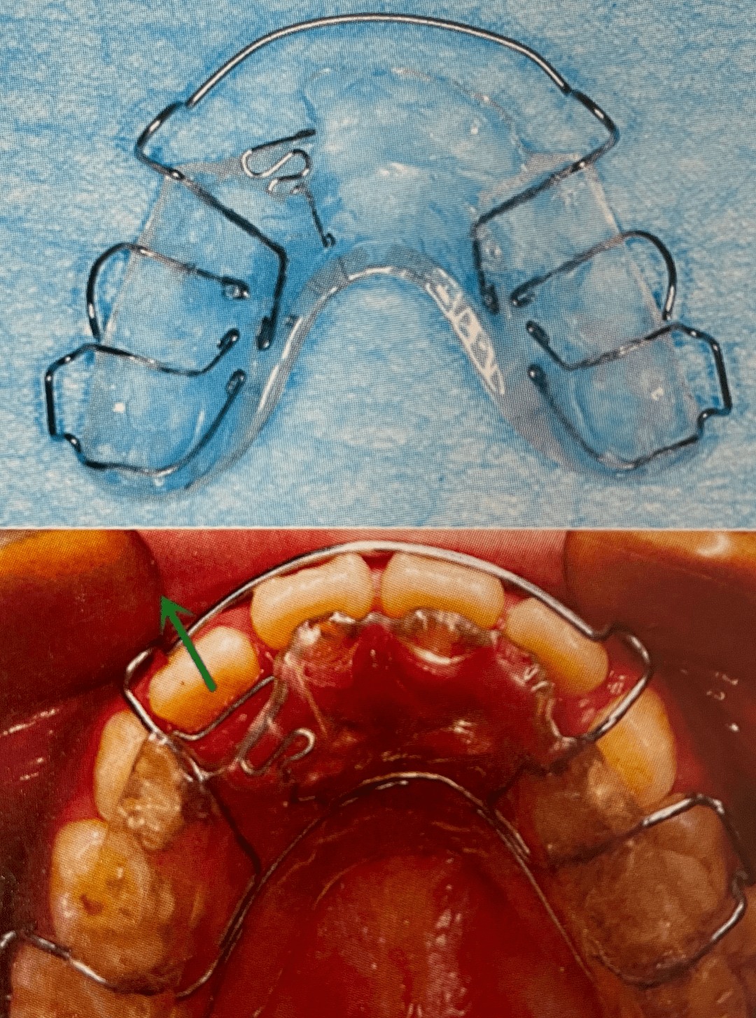 乳牙反颌矫正器种类图片