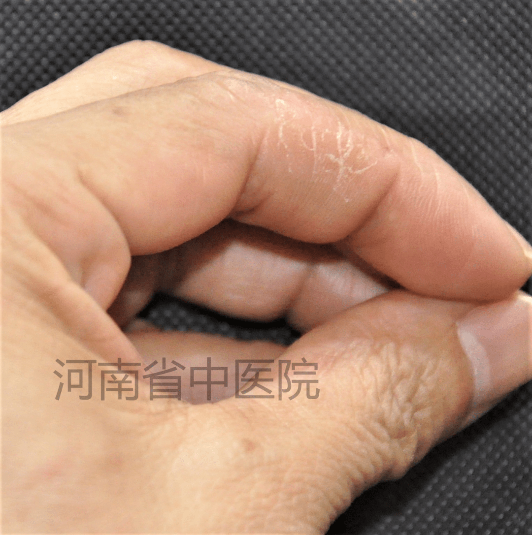 刘爱民教授皮肤病辨治典型案例分享54手部神经性皮炎1例
