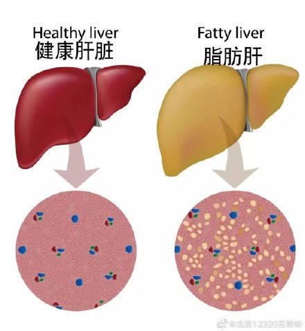 肝功能|脂肪肝到底是不是疾病？