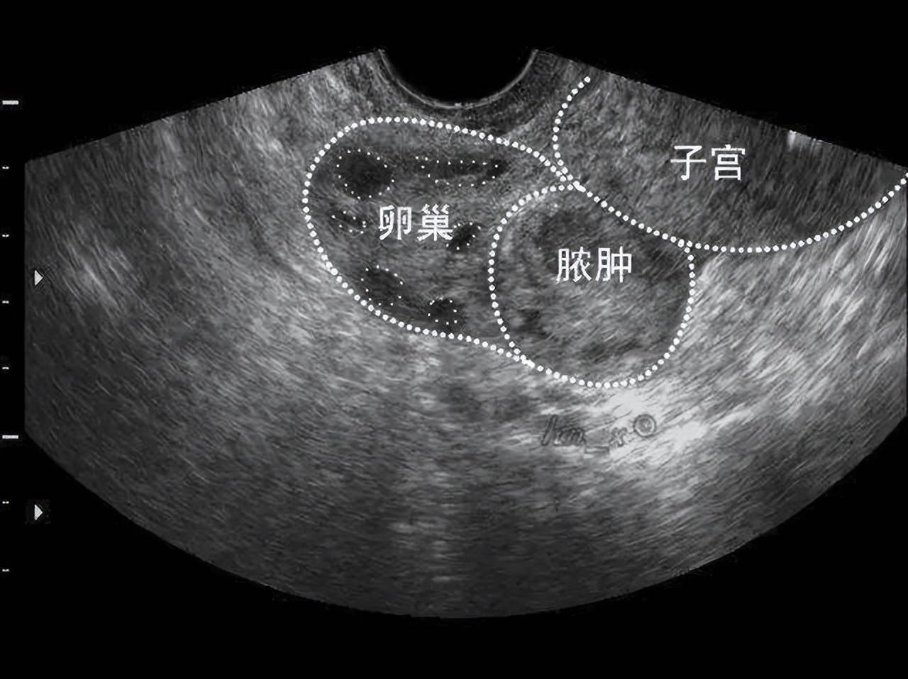 正常子宫B超图片