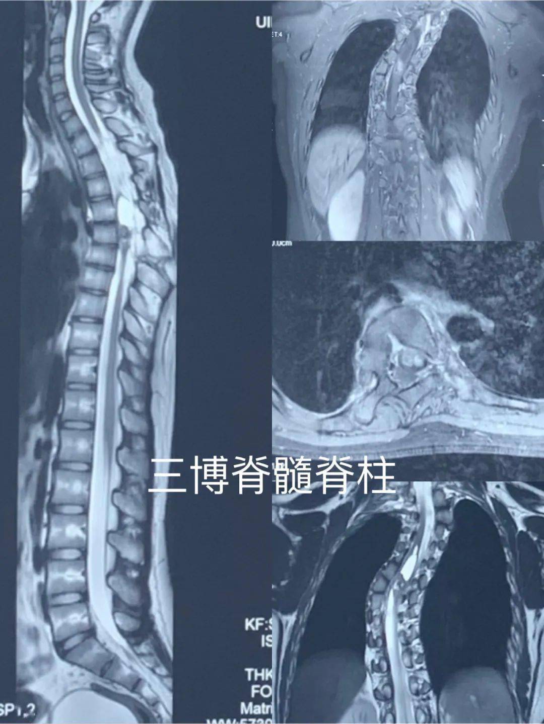 畸形胎儿椎体图片