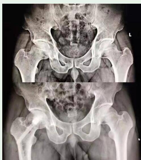 陶瓷棒修复坏死股骨头,30岁小伙微创手术成功保髋_治疗_患者_髋关节