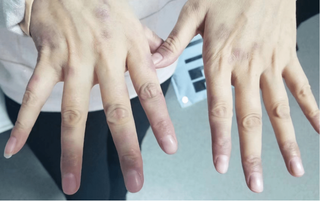 肺癌的早期手指图片