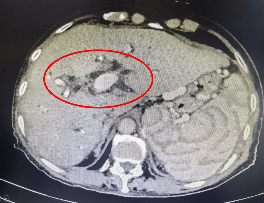 利用药物为苏阿姨进行利胆护肝治疗,手术过程中,在b超的定位和引导下