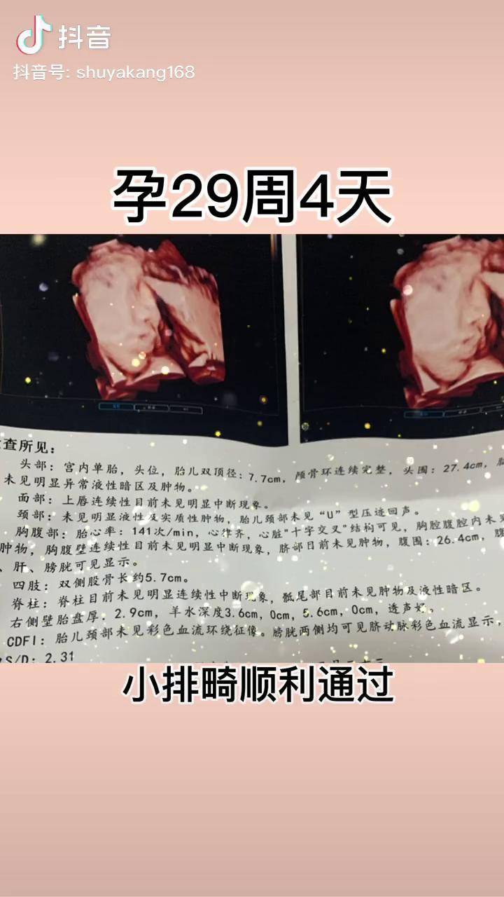 孕29周4天预产期5月7今天小排畸也顺利通过了一路