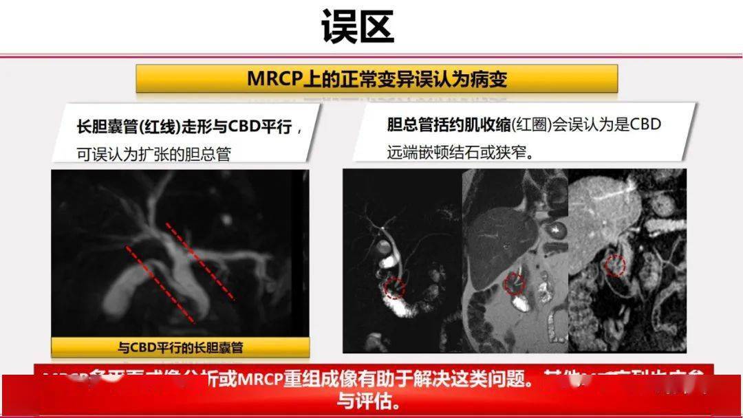 磁共振胰膽管成像mrcp放射科醫生必須知道的專業知識