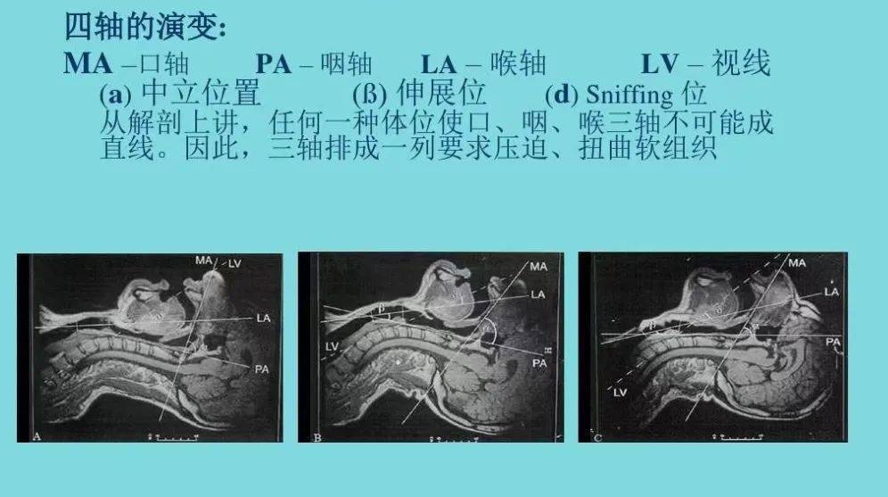 初学者如何快速掌握光棒引导下气管插管