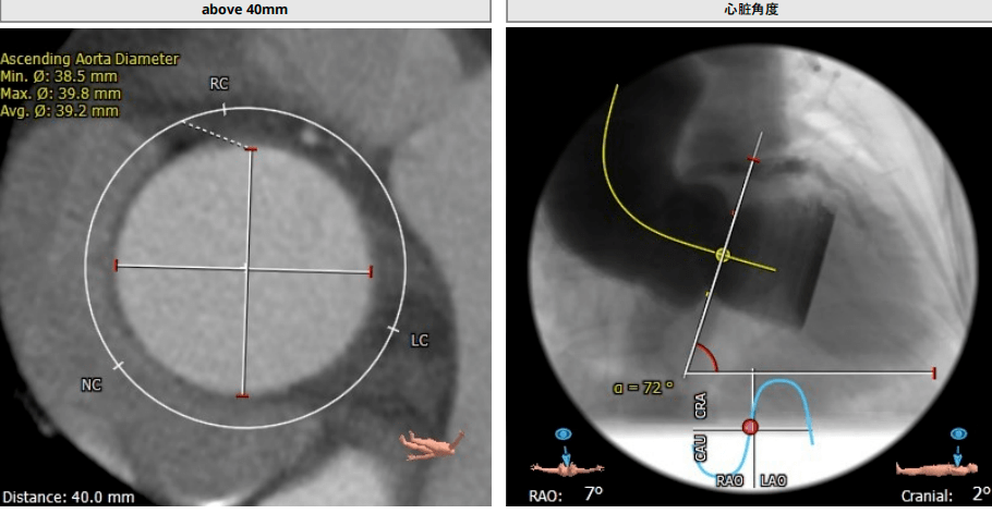 浙江省台州医院江建军主任团队完成一例高难度type0二叶瓣横位心tavr