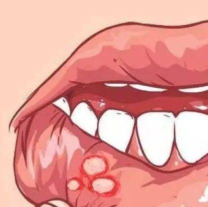 又得口腔溃疡，为什么总是我？_免疫_黏膜_症状