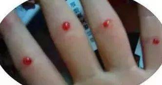 扎四缝,扎一次立竿见影,真是绝了_手指_孩子_黄水